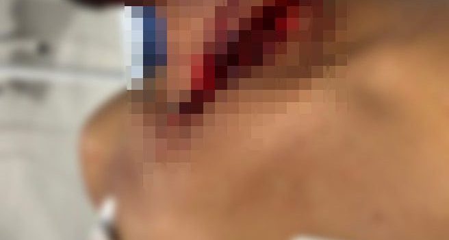 Esposa corta o pescoço do marido com navalha após ele negar sexo em MT; imagem forte