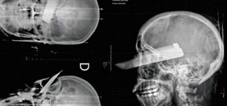 ‘Cheirado de pó’, homem crava faca no olho da esposa e a deixa cega após crise de ciúmes; PM prendeu o suspeito