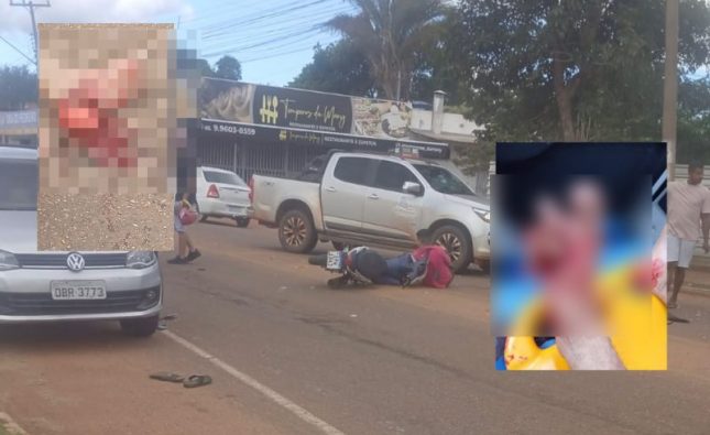 Motociclista tem dedos dilacerados e pé esfacelado após acidente entre motos em Rondonópolis; imagens fortes