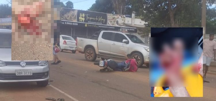 Motociclista tem dedos dilacerados e pé esfacelado após acidente entre motos em Rondonópolis; imagens fortes