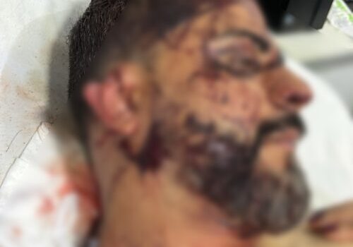 Imagem mostra vereador com parte da orelha decepada após ato criminoso em Rondonópolis