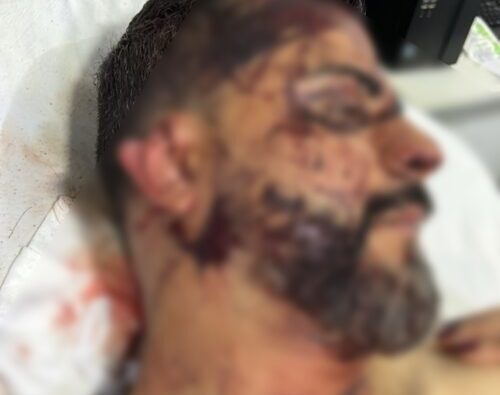Imagem mostra vereador com parte da orelha decepada após ato criminoso em Rondonópolis